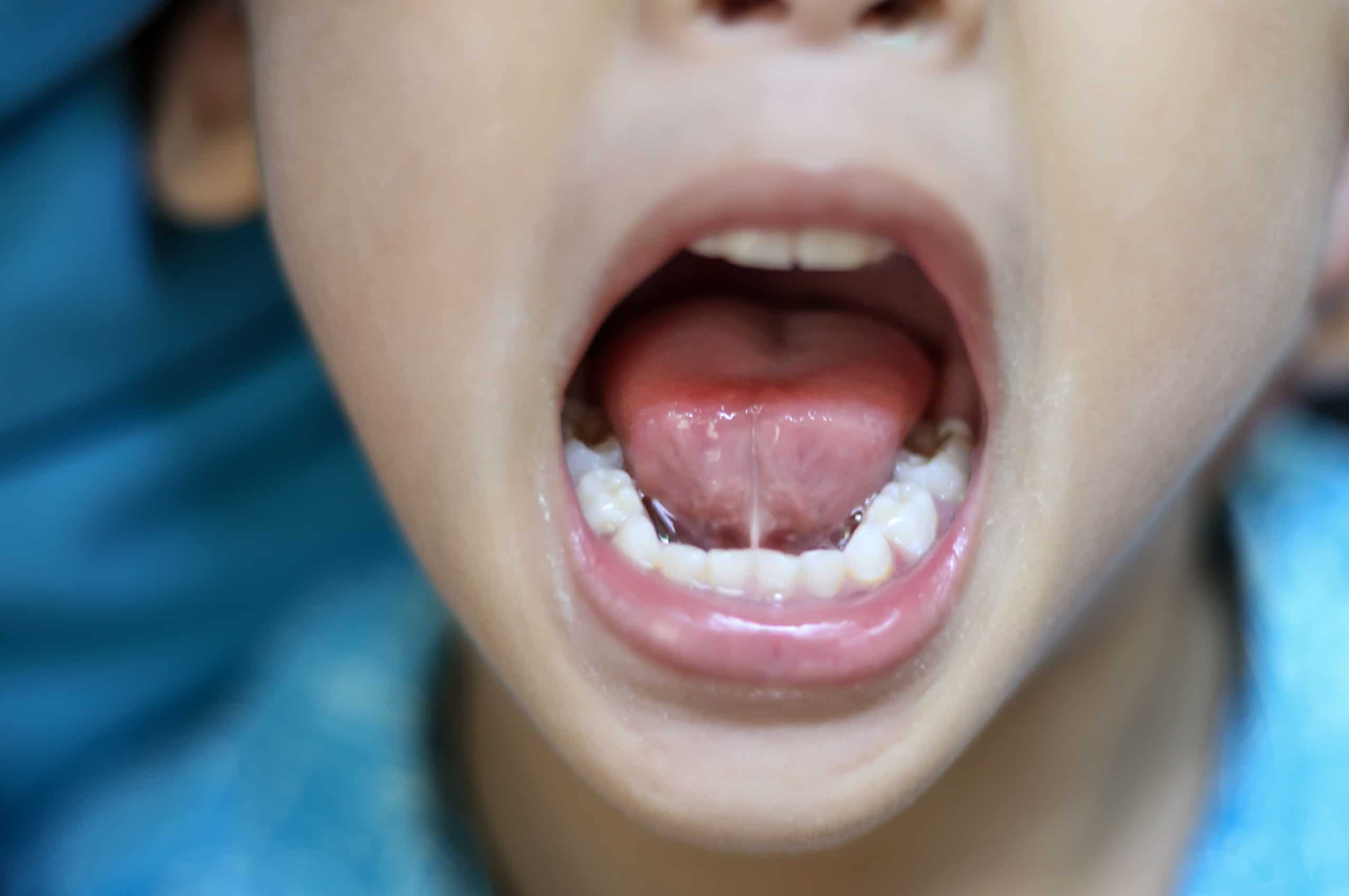 Lip & Tongue Tie Seahorse Kids Dental Pediatric Dentist in Harbor